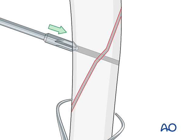 The hole is slightly countersunk to enlarge the contact area of the screw head to the bone