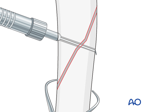 The screw length is measured with a depth gauge