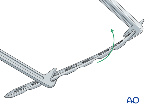 Locking plates may need some contouring; they should not be more than 2 mm away from the surface of the bone