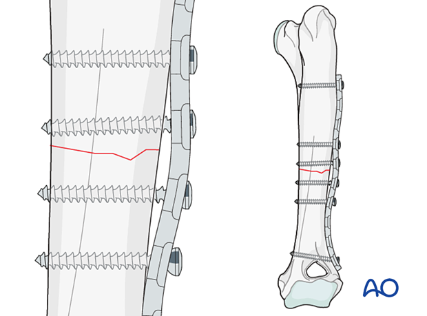 Compression plates must be overbent to produce a 1-2 mm gap between the plate and the bone at the fracture sites