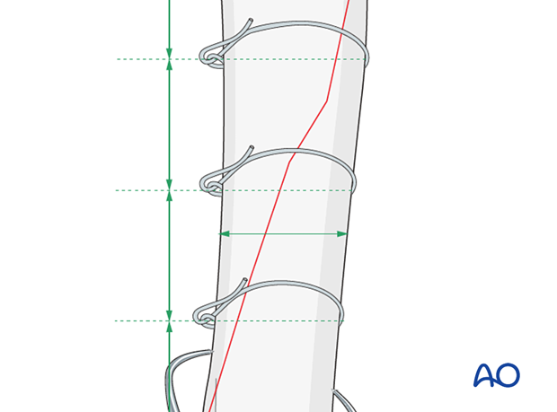 The distance between the cerclage wires must be at least 0.5 bone diameter away from the tip of the fragment