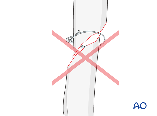 Placing cerclage wires on a short oblique fracture will generate larger shear forces, causing loss of reduction, the fracture to shear, and collapse