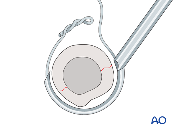 The cerclage wire is placed around the bone