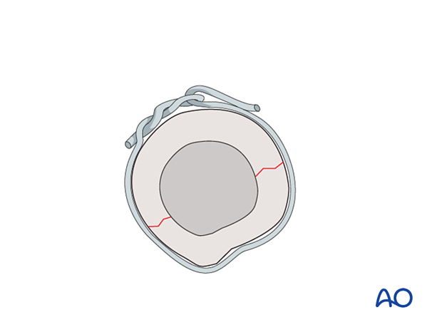 Twist knot, single loop, or double loop cerclage wire can be used