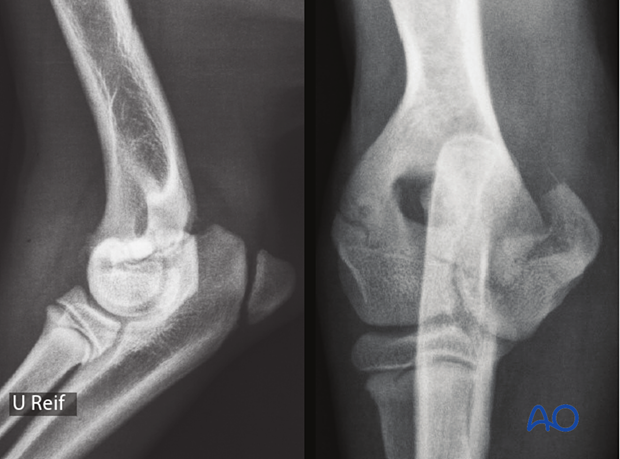 AP and lateral x-rays of a medial partial articular fracture of the dog distal humerus