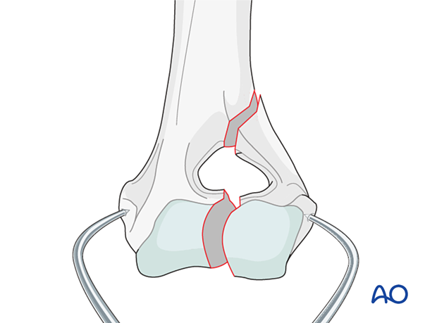 D13_P010_i040 The fracture is manually reduced and secured using large, pointed reduction forceps