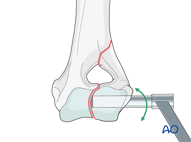 D13_P010_i140 The fracture is manually reduced and secured using an appropriately sized drill guide