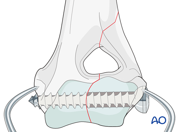 D13_P010_i240 If using a lag screw, the screw hole in the condylar fragment is overdrilled to the appropriate size for the screw