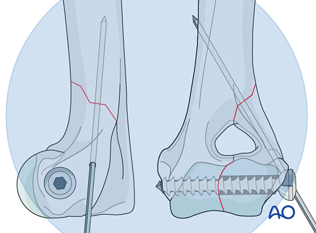 D13_P010_i320 approach to the le fort i level of the midface in cleft lip and palate patients