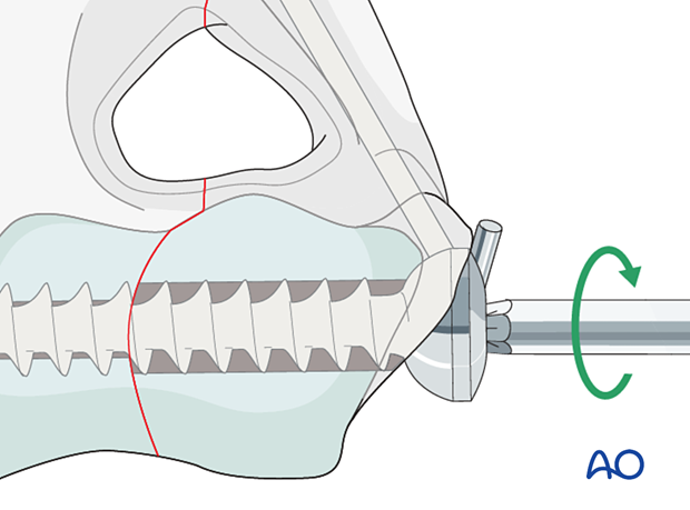 D13_P010_i360 approach to the le fort i level of the midface in cleft lip and palate patients