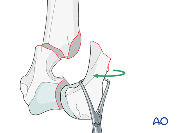 Transcondylar screw and bilateral antirotational pins for Simple ...
