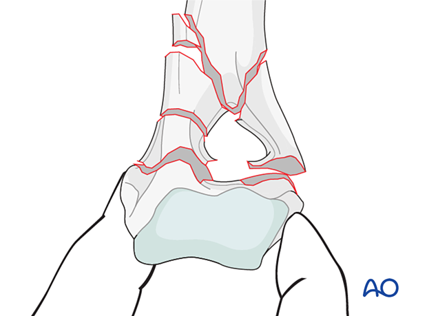 External skeletal fixator for Complex extra-articular