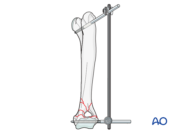 External skeletal fixator for Complex extra-articular