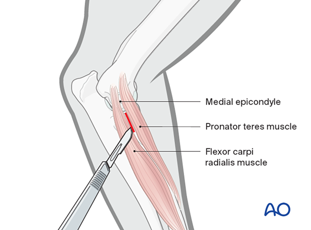 Approach for minimally invasive osteosynthesis (MIO) of the dog radial ...