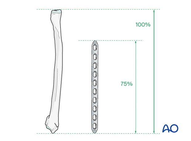 Bridging plate for Complex fracture of the diaphyseal radius with
