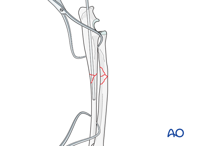 Lag screw and neutralization plate on radius with intramedullary pin or ...