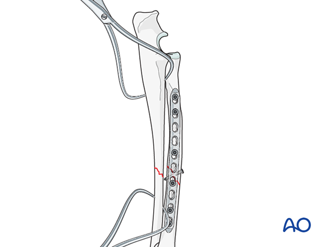 Lag screw and neutralization plate on radius with intramedullary pin or ...
