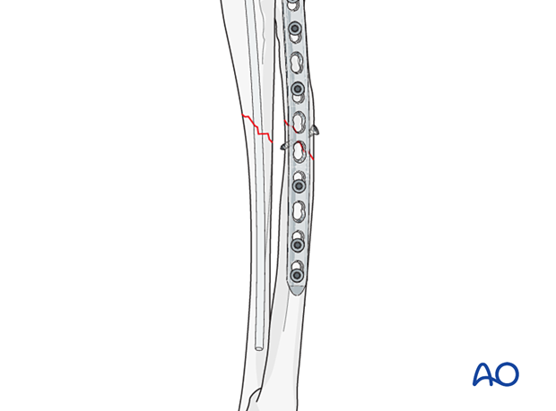 Lag screw and neutralization plate on radius with intramedullary pin or ...