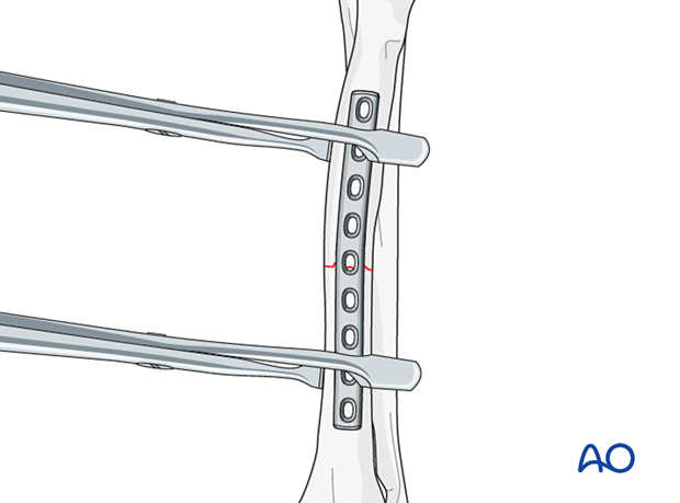 Compression plate for Incomplete fracture of the diaphyseal radius or ...