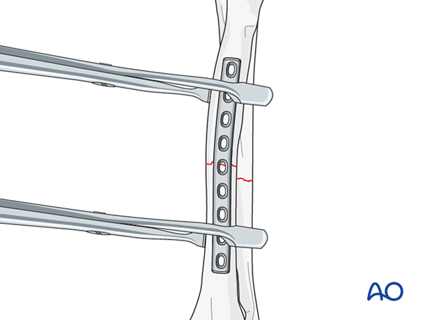 Solidworkd Compression Plates Compression plate for Simple fracture of the distal zone of the ...