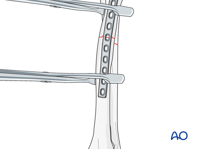 Compression plate for Simple fracture of the proximal zone of the ...