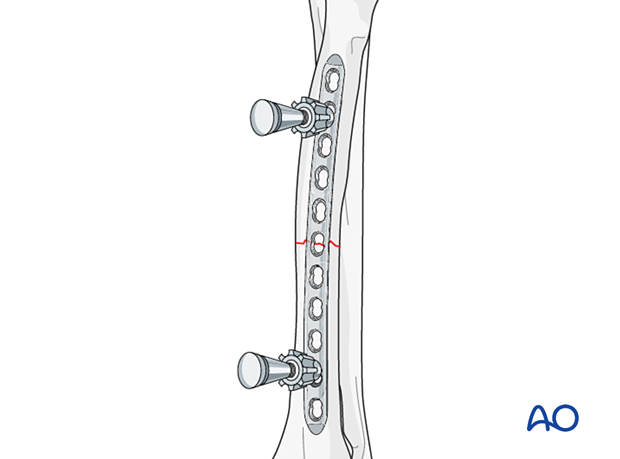 Compression plate for Incomplete fracture of the diaphyseal radius or ...