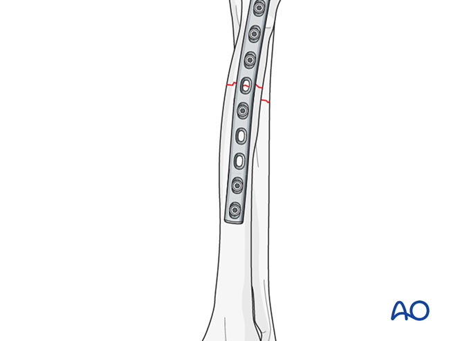 Compression plate for Simple fracture of the proximal zone of the ...
