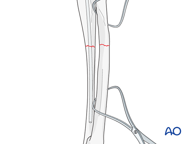 Intramedularry Pin Compression plate on radius with intramedullary pin or plate on ulna ...