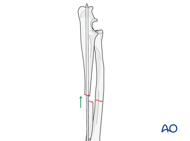 Compression plate on radius with intramedullary pin or plate on ulna ...