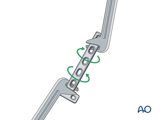 Compression T-plate for Simple fracture of the distal zone of the ...