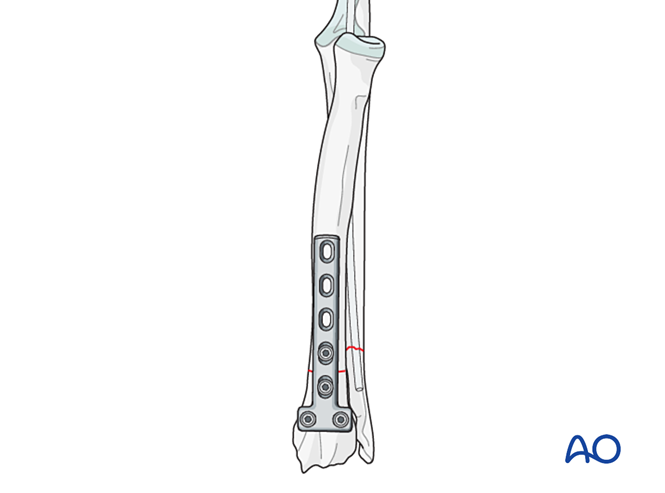 Lateral Compression Plate Compression T-plate on radius with intramedullary pin or lateral plate ...