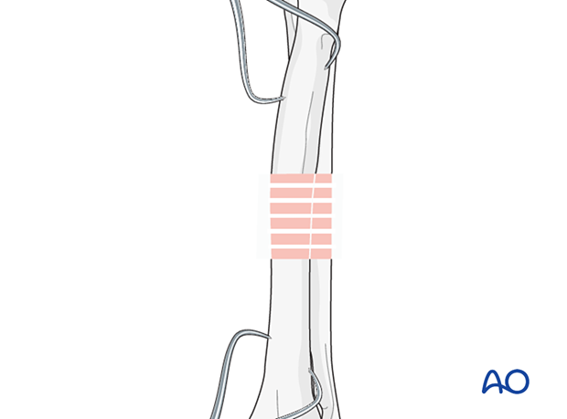Bridging plate for Complex fracture of the diaphyseal radius with