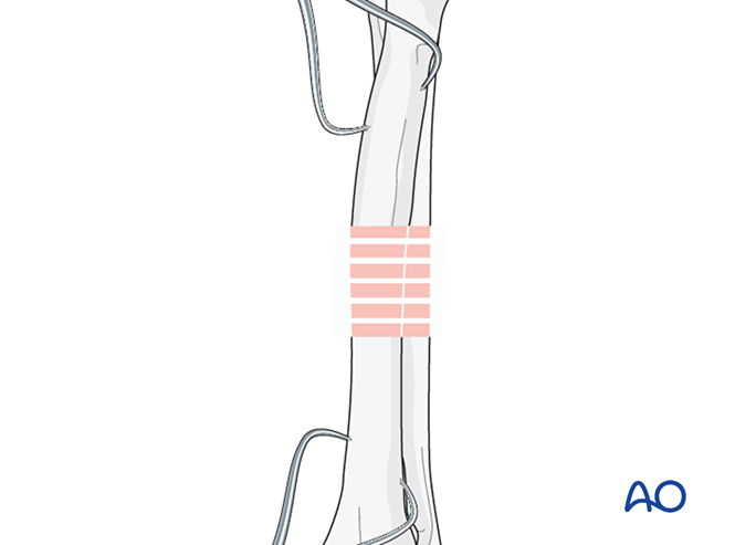 Bridging plate for Wedge fracture of the diaphyseal radius with simple ...