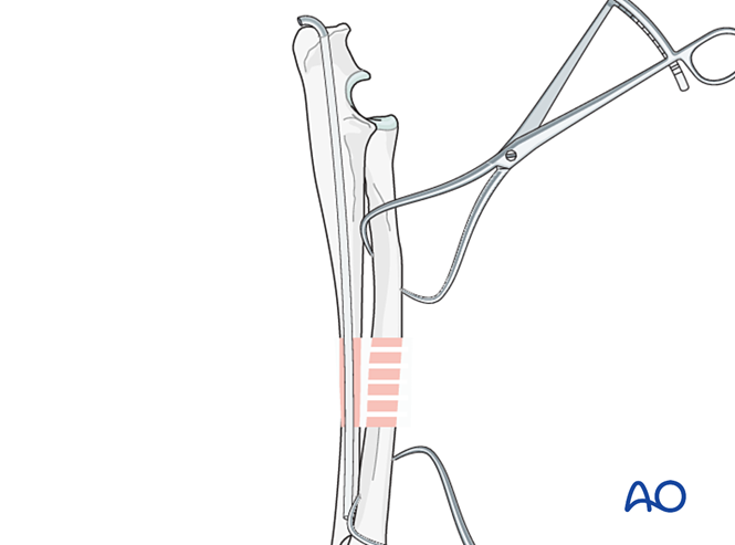 Bridging plate on radius and intramedullary pin or plate on ulna for ...