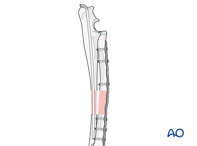 Bridging plate on radius and intramedullary pin or plate on ulna for ...