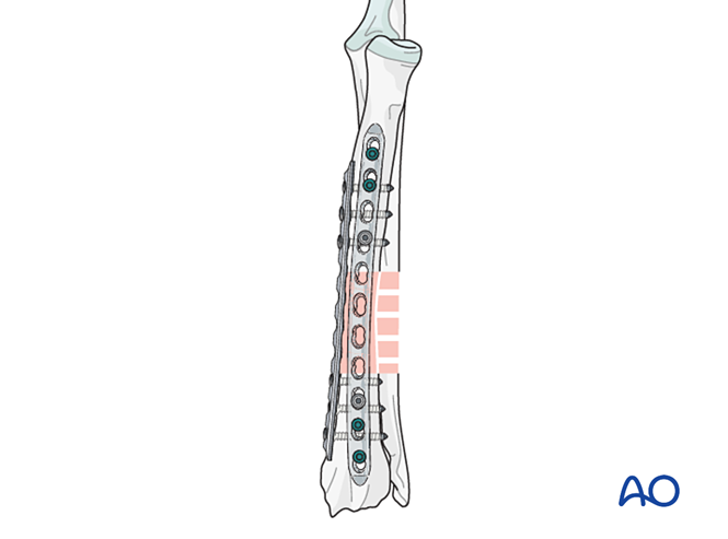Orthogonal bridging plates for Complex fracture of the diaphyseal ...