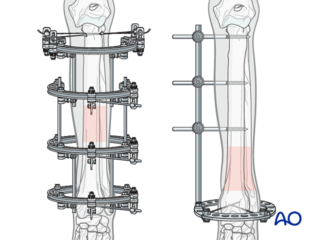 Circular or hybrid external skeletal fixator for Complex fracture of ...