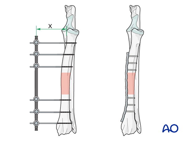General considerations on external skeletal fixators
