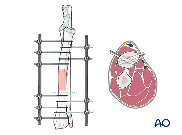 General considerations on external skeletal fixators