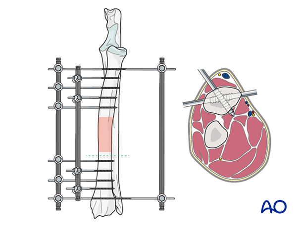 General considerations on external skeletal fixators