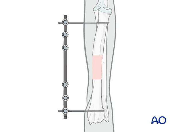 General considerations on external skeletal fixators