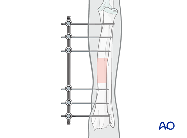 General considerations on external skeletal fixators