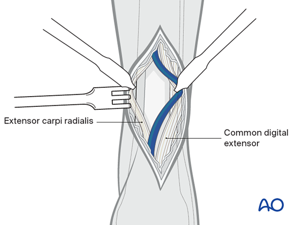 Retraction of tendons to expose the dorsal surface of the distal radius.