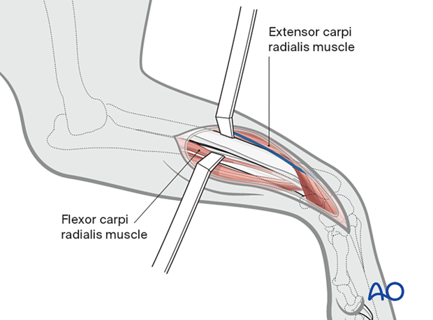 Lateral and caudal retraction of extensor carpi radialis and flexor carpi radialis, respectively.