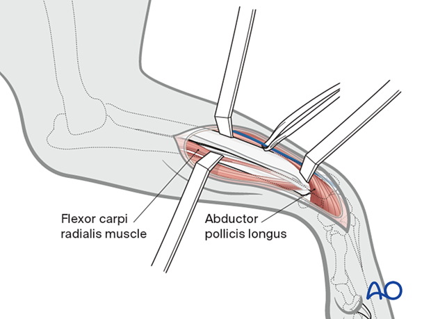 Isolation of the abductor pollicis longus muscle and medial isolation of the extensor carpi radialis.