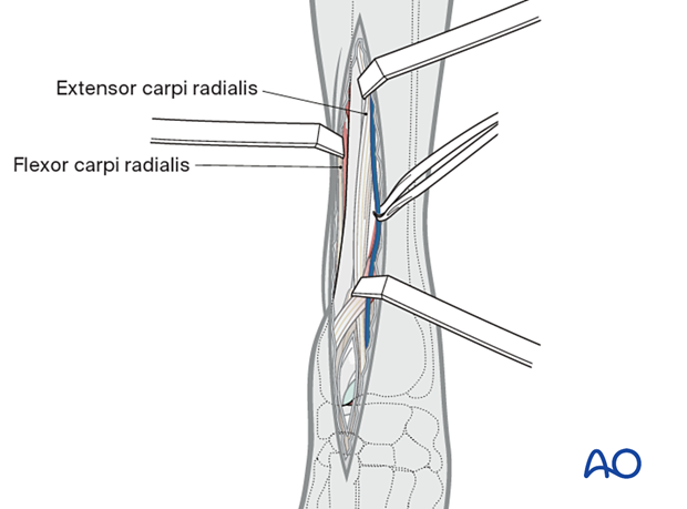 Dorsal arthrotomy for articular fracture repair.