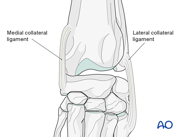 Preserved medial collateral ligament for treatment of intraarticular fractures