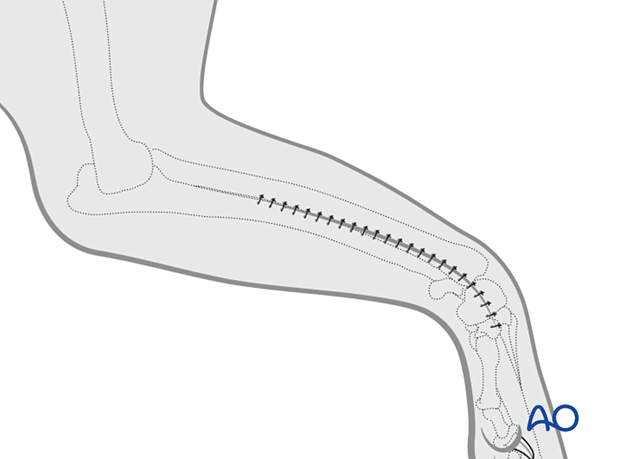 Closure after an arthrotomy
