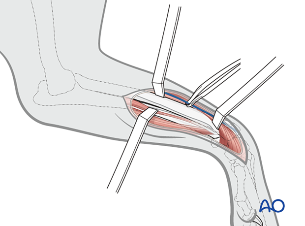 Craniomedial approach to the distal radius