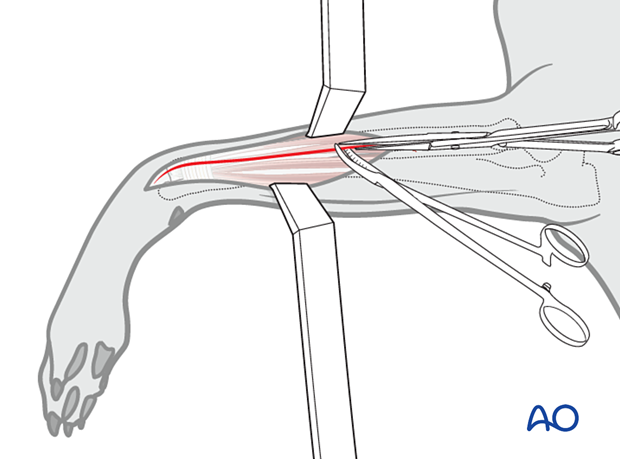 The subcutaneous tissue is dissected along the same line as the skin